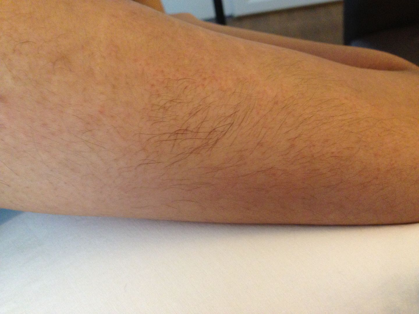 "Aftermath" of electrolysis Tips For Skin Care HairTell Hair Removal Forums